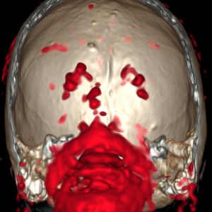 M. Parkinson Lewy-Body-Disease F-DOPA PET/CT M. Parkinson Lewy-Body-Disease F-DOPA PET/CT