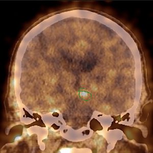 M. Parkinson nigrostriatale Degeneration M. Parkinson nigrostriatale Degeneration