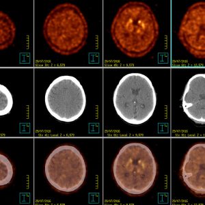 M. Parkinson nigrostriatale Degeneration F-DOPA PET/CT M. Parkinson nigrostriatale Degeneration F-DOPA PET/CT
