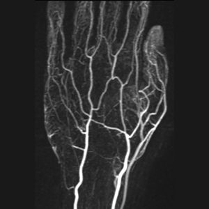 MR-Angiographie Hand mit KM o.B. MR-Angiographie Hand mit KM o.B.
