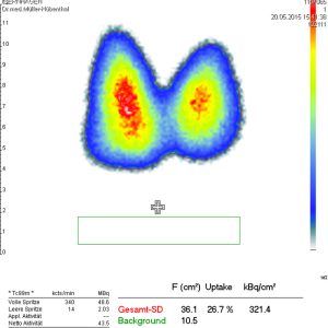M. Basedow Tc88m Uptake 26 M. Basedow Tc88m Uptake 26