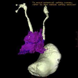 M. Ormond retroperitoneale Fibrose MRT-VR