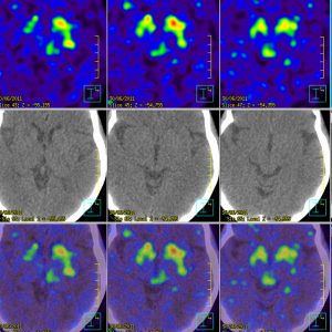 M. Parkinson F-DOPA PET/CT M. Parkinson F-DOPA PET/CT
