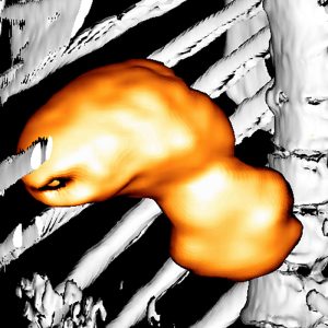 Magencarcinom FDG-PET/CT Magencarcinom FDG-PET/CT