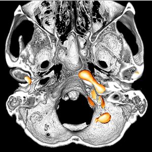 MammaCa Schädelbasismetastase FDG-PET/CT