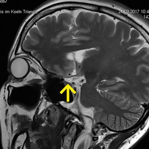 Multiple Sklerose Neuritis nevi optici MRT-parasag-T2W