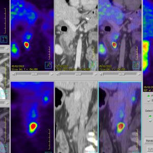 NET Neuroendokriner Tumor Gastrinom Zollinger Ellison Ga68-DOTATOC-PET/CT NET Neuroendokriner Tumor Gastrinom Zollinger Ellison Ga68-DOTATOC-PET/CT