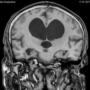 NPH Normaldruckhydrocephalus Verlangsamung kleinschrittiges Gangbild Inkontinenz MRT cor T1W NPH Normaldruckhydrocephalus Verlangsamung kleinschrittiges Gangbild Inkontinenz MRT cor T1W