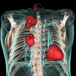 NSCLC und TBC VR NSCLC und TBC VR
