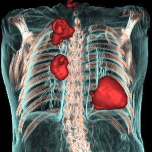 NSCLC und Tuberkulose FDG-PET/CT-VR NSCLC und Tuberkulose FDG-PET/CT-VR