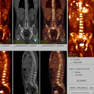 NSCLC rechter Oberlappen generalisierte ossäre Metastasen CEA 3110 FDG-PET/CT NSCLC rechter Oberlappen generalisierte ossäre Metastasen CEA 3110 FDG-PET/CT