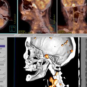 Nasopharynxkarzinom FDG-PET/CT