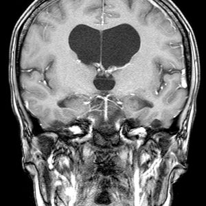 Normaldruckhydrocephalus kleinschrittiges Gangbild Normaldruckhydrocephalus kleinschrittiges Gangbild