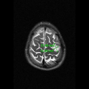 Oligoastrozytom Grad II links MRT-T2W-axial Oligoastrozytom Grad II links MRT-T2W-axial