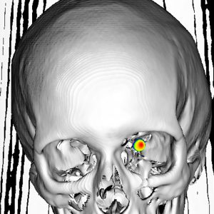 Optikusmeningeom 3D-Ga68-DOTATOC-PET/CT