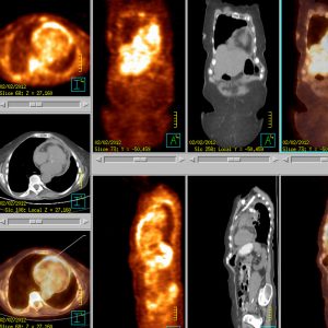 Perikarditis FDG-PET/CT Perikarditis FDG-PET/CT