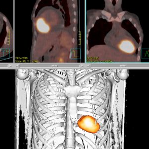 Perikardmetastase Cervix Ca FDG-PET/CT Perikardmetastase Cervix Ca FDG-PET/CT