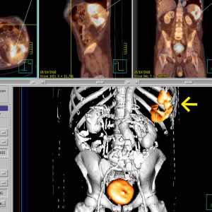 Perilienaler Milzabszess FDG-PET/CT Perilienaler Milzabszess FDG-PET/CT