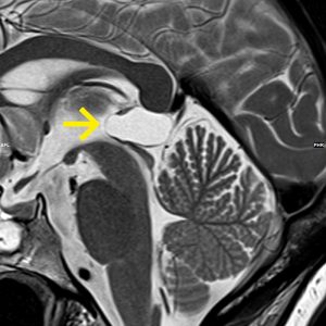 Pinealiszyste kein Parinaud-Syndrom sagT2-MRT