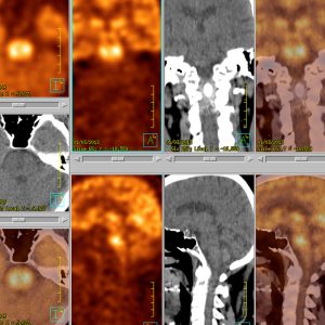 Ponsgliom FDG-PET/CT Ponsgliom FDG-PET/CT