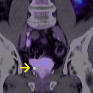 Prostatakarzinom Lokalrezidiv bei Kapseldurchbruch F18-PSMA-PET/CT