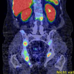 Prostatakarzinom Skelettmetastasen F18-PSMA-PET/CT Prostatakarzinom Skelettmetastasen F18-PSMA-PET/CT
