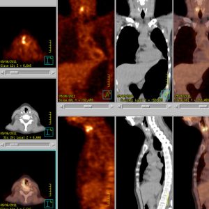 Recurrensparese FDG-PET/CT