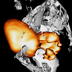 Rektumkarzinom mit Abzess FDG-PET/CT Rektumkarzinom mit Abzess FDG-PET/CT