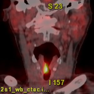 Stimmlippenkrebs rechts FDG-PET/CT