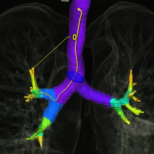Trachealbaum low-dose-CT Trachealbaum low-dose-CT