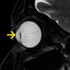 Z.n. Linsen-OP MRT-T2W-sag