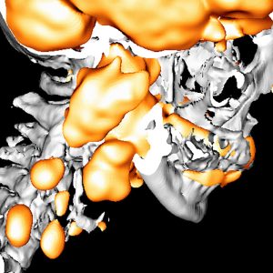 Zungengrundkarzinom cervikale Lymphknotenmetastasen FDG-PET/CT Zungengrundkarzinom cervikale Lymphknotenmetastasen FDG-PET/CT